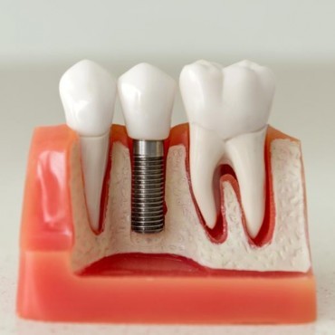 Implante Dentário em Vigia