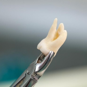 Extração de Dente em Vigia