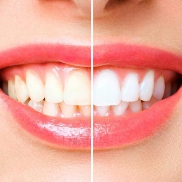 Clareamento Dental em Vigia
