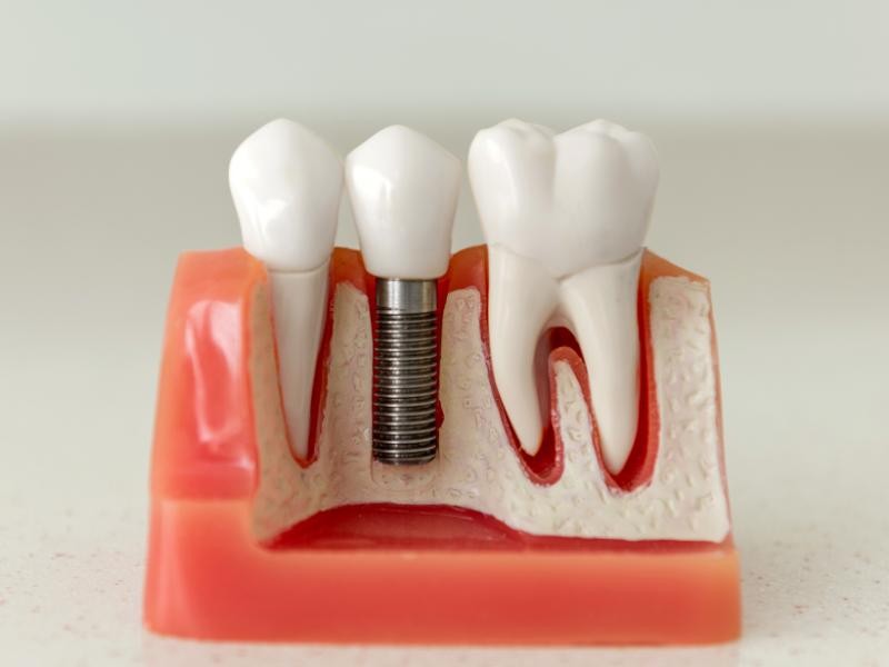Implante Dentário