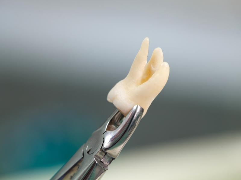 Extração de Dente
