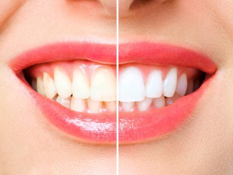 Clareamento Dental