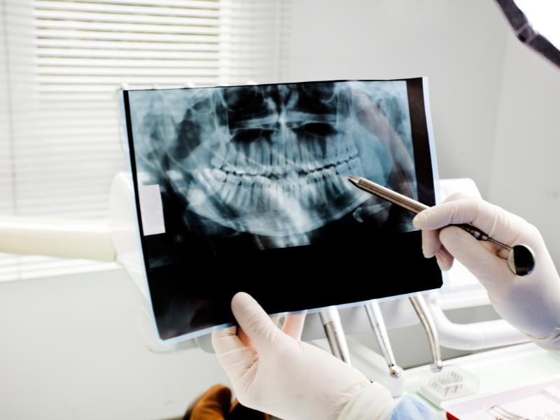 Raio-X Periapical